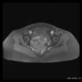 Broad ligament fibroid (Radiopaedia 49135-54241 Axial T1 fat sat 20).jpg