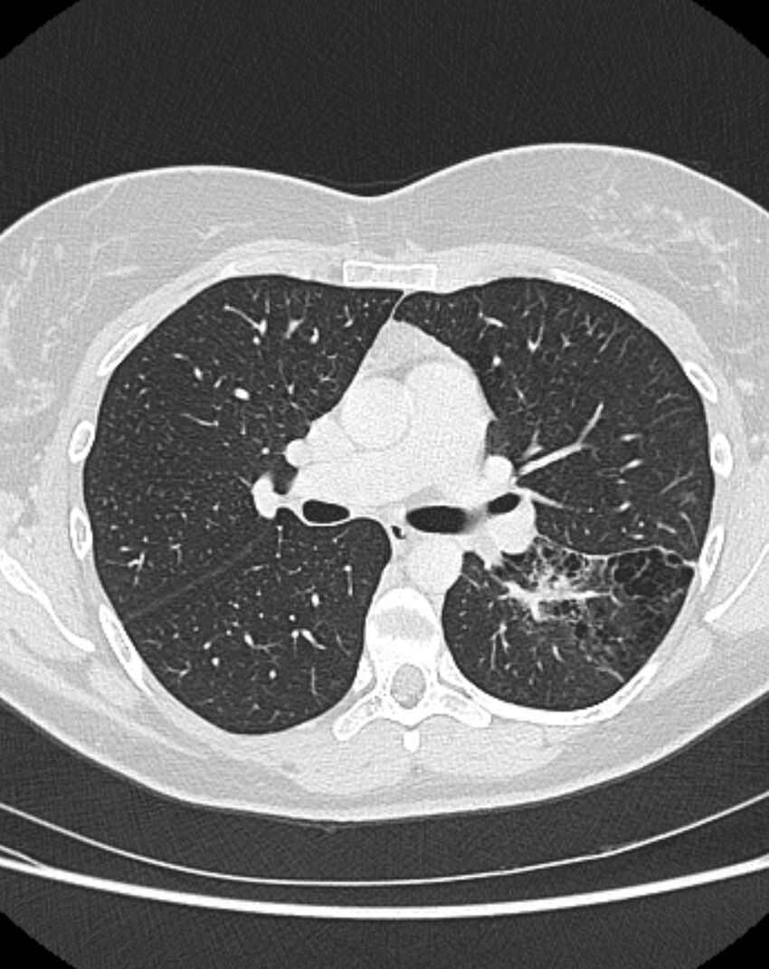 Bronchial atresia (Radiopaedia 50007-55297 Axial lung window 45).jpg