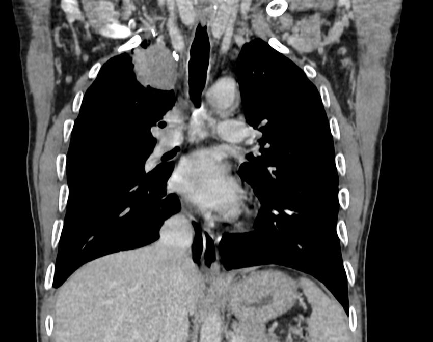 Bronchogenic carcinoma with superior vena cava syndrome (Radiopaedia 36497-38054 Coronal C+ delayed 44).jpg