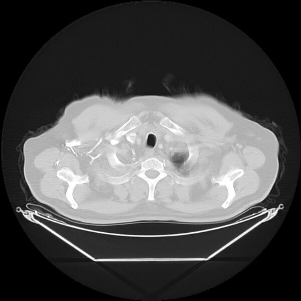 File:Bronchogenic carcinoma with upper lobe collapse (Radiopaedia 29297-29726 Axial lung window 5).jpg