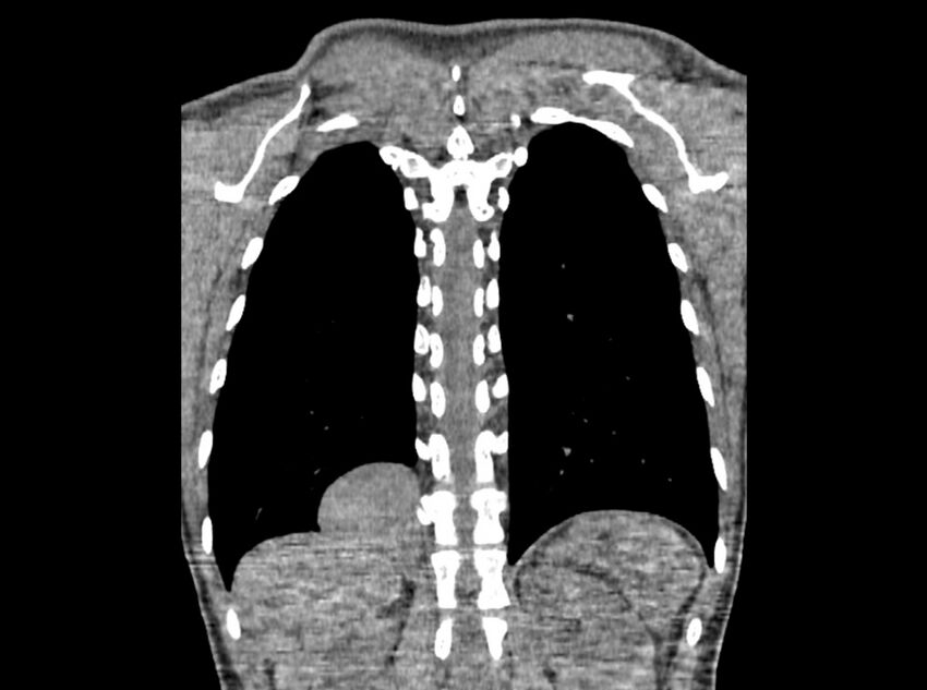 Bronchogenic cyst (Radiopaedia 80273-93615 D 107).jpg