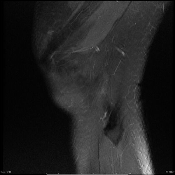 File:Bucket handle tear - lateral meniscus (Radiopaedia 7246-8187 Sagittal T2 fat sat 4).jpg