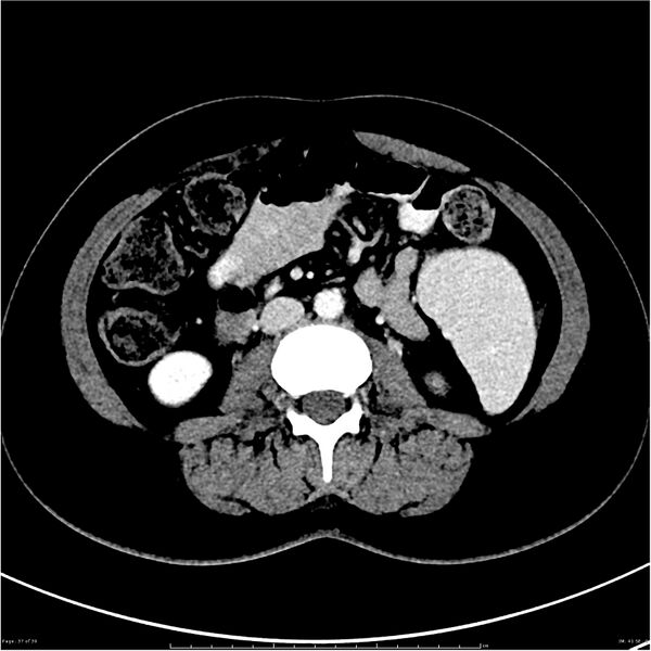 File:Budd-Chiari syndrome (Radiopaedia 27929-28177 Axial liver window 37).JPG
