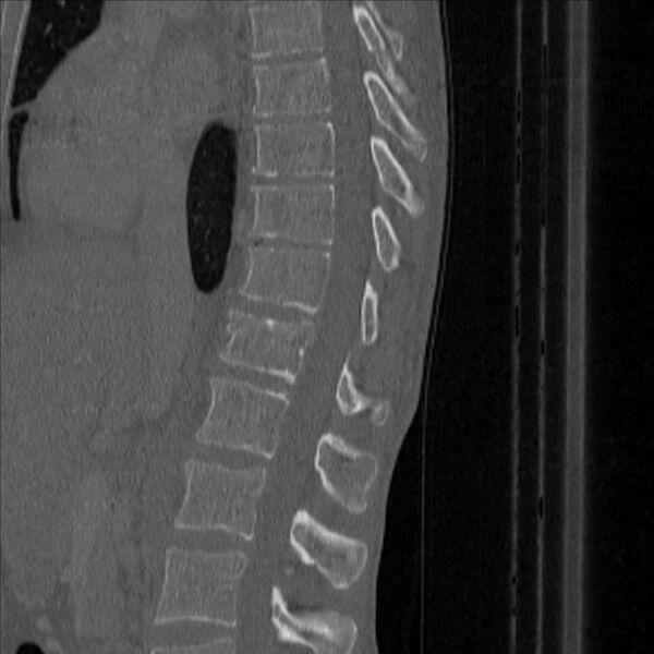 File:Bulging of paraspinal line in traumatic thoracal spinal compression fracture (Radiopaedia 29221-35872 Sagittal bone window 25).jpg