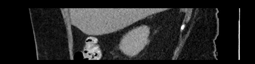 Buried bumper syndrome - gastrostomy tube (Radiopaedia 63843-72575 Sagittal Inject 100).jpg