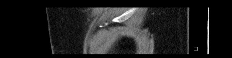 File:Buried bumper syndrome - gastrostomy tube (Radiopaedia 63843-72575 Sagittal Inject 6).jpg