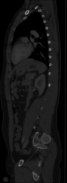 File:Burst fracture (Radiopaedia 83168-97542 Sagittal bone window 82).jpg