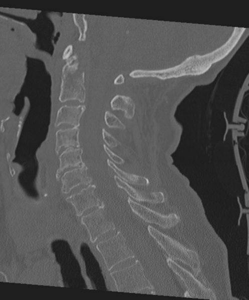 File:C2 fracture with vertebral artery dissection (Radiopaedia 37378-39199 Sagittal bone window 38).png