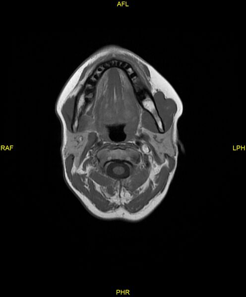 File:C5 nerve sheath tumor (Radiopaedia 85777-101596 Axial T1 5).jpg
