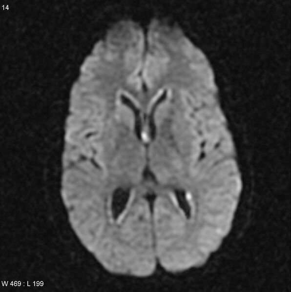 File:CMV ventriculitis and encephalitis (Radiopaedia 5416-7166 Axial DWI 3).jpg