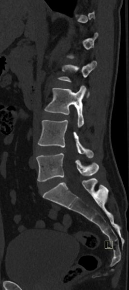 File:Calcaneal fractures with associated L2 burst fracture (Radiopaedia 71671-82493 Sagittal bone window 47).jpg