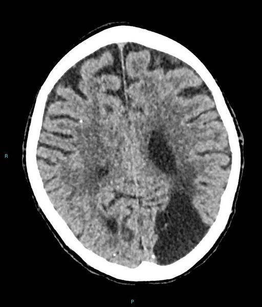 File:Calcified cerebral emboli from left ventricular thrombus (Radiopaedia 84420-99758 Axial non-contrast 34).jpg