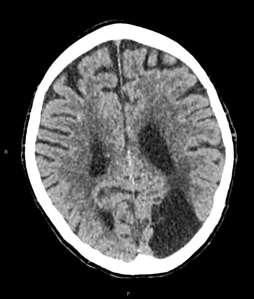 File:Calcified cerebral emboli from left ventricular thrombus (Radiopaedia 84420-99758 Axial non-contrast 35).jpg