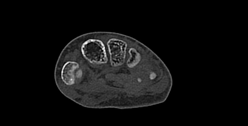 File:Calcifying aponeurotic fibroma (Radiopaedia 88423-105064 Axial bone window 124).jpg