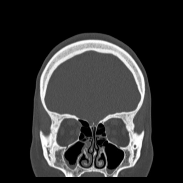 File:Calvarial osteoma (Radiopaedia 36520-38079 C 23).jpg