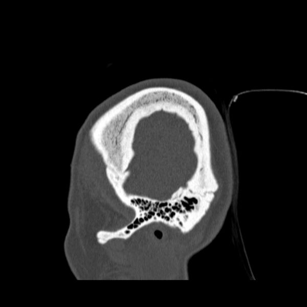 File:Calvarial osteoma (Radiopaedia 36520-38079 Sagittal bone window 13).jpg