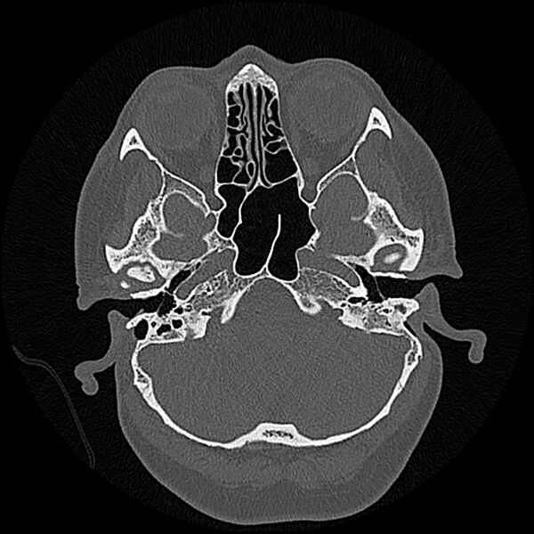 File:Canal up mastoidectomy (Radiopaedia 78108-90638 Axial bone window 54).jpg