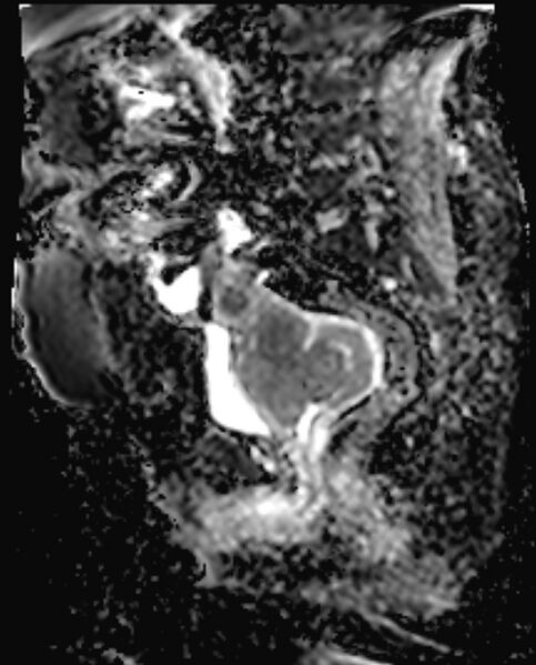 File:Cancer cervix - stage IIb (Radiopaedia 75411-86615 Sagittal ADC 10).jpg
