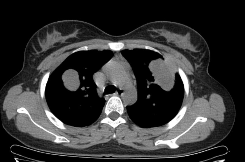 Cannonball metastases - uterine choriocarcinoma (Radiopaedia 70137-80173 Axial non-contrast 30).jpg
