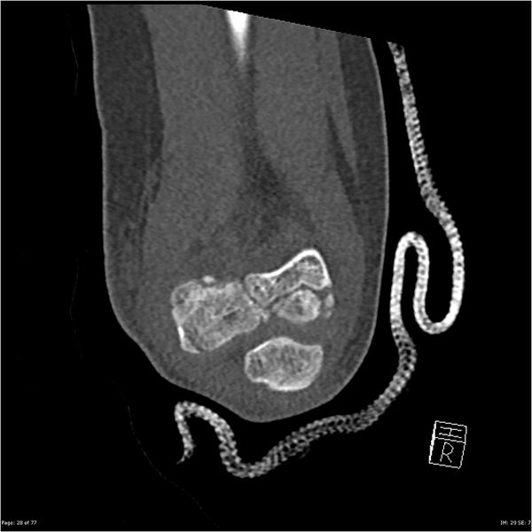 File:Capitellum fracture (Radiopaedia 23352-23426 Coronal bone window 28).jpg