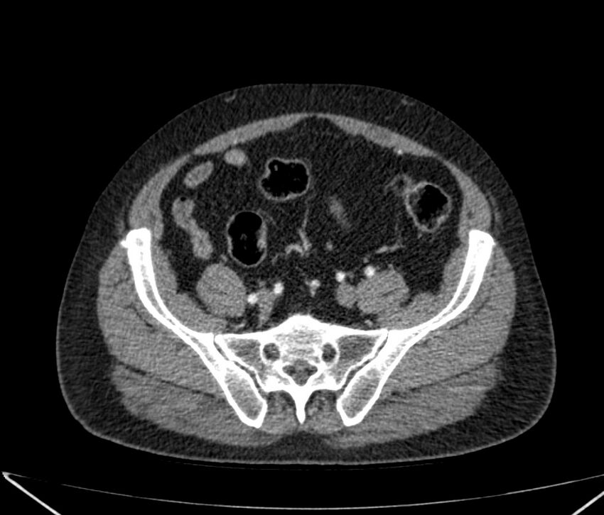 Carcinoid tumor with hepatic metastases (Radiopaedia 22651-22670 B 75).jpg