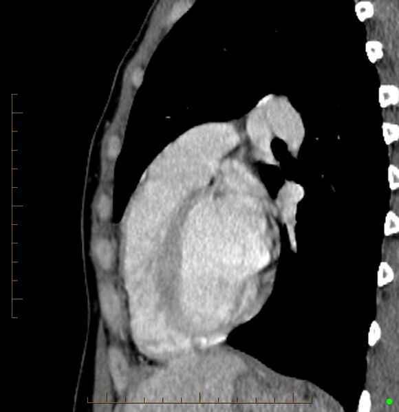 File:Cardiac paraganglioma (Radiopaedia 76345-88005 C 34).jpg