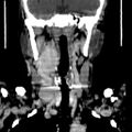 Carotid body tumor (Radiopaedia 27890-28124 B 10).jpg