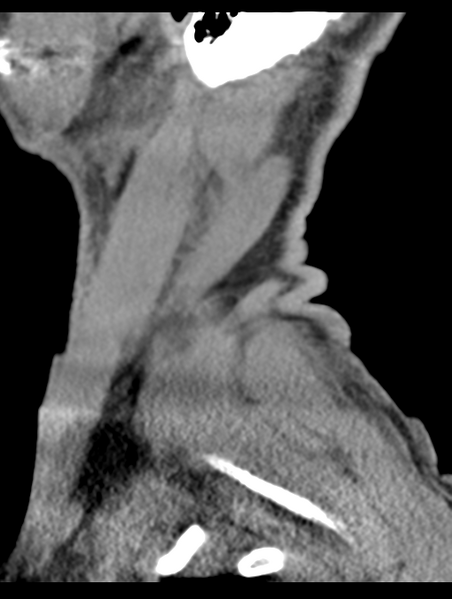 File:Cavernoma of cervical cord (Radiopaedia 50838-56346 B 77).png