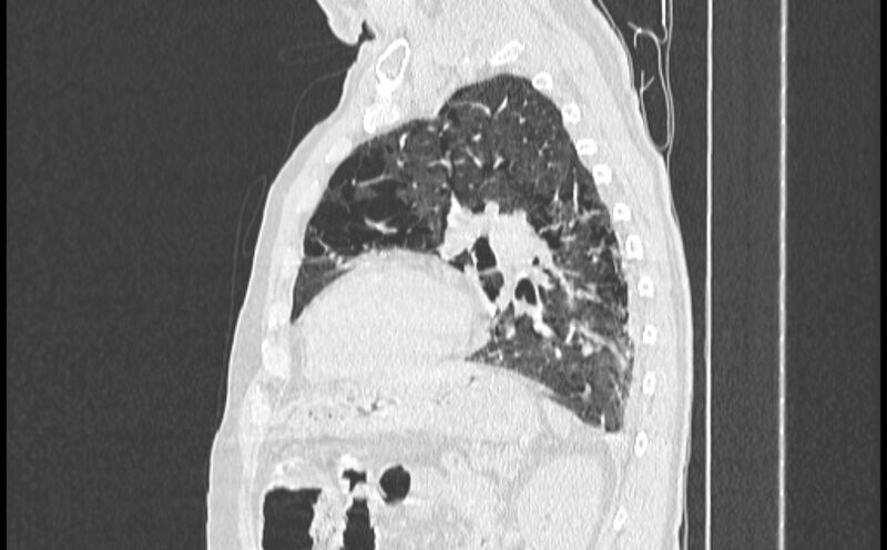 File:Cavitating bronchogenic carcinoma (Radiopaedia 44489-48162 Sagittal lung window 44).jpg