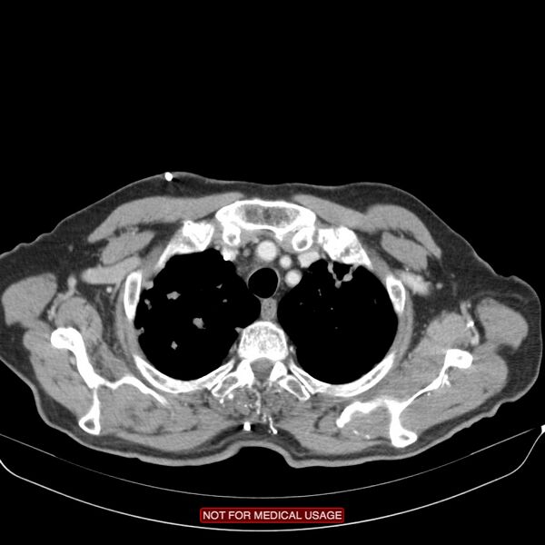 File:Cavitating pulmonary metastases (Radiopaedia 24920-25184 B 2).jpg