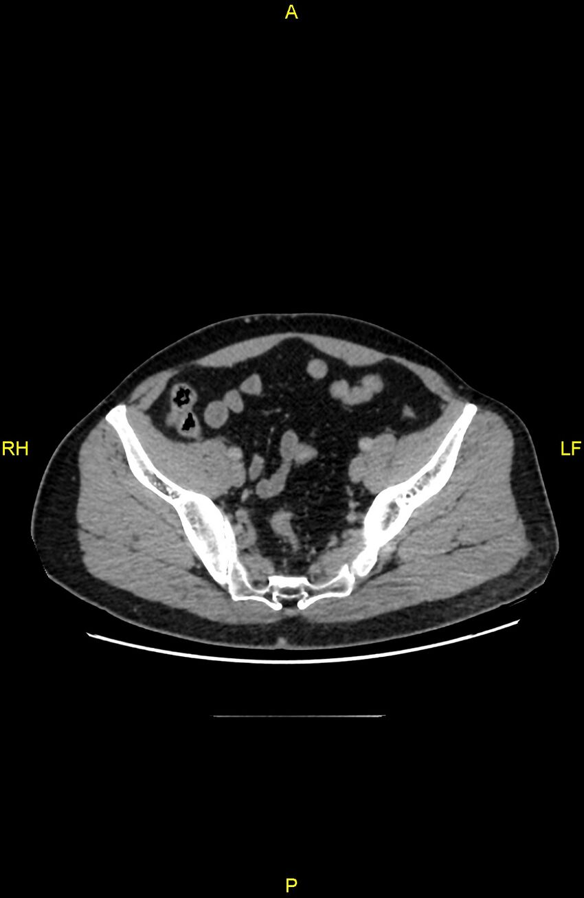 Cecal epiploic appendagitis (Radiopaedia 86047-102164 A 125).jpg