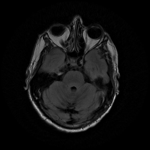 File:Central neurocytoma (Radiopaedia 67618-77021 Axial FLAIR 8).jpg