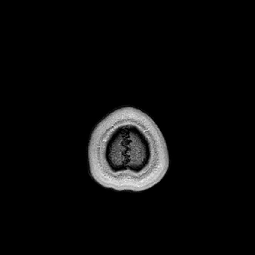 Central neurocytoma (Radiopaedia 79320-92380 Axial T1 C+ 230).jpg