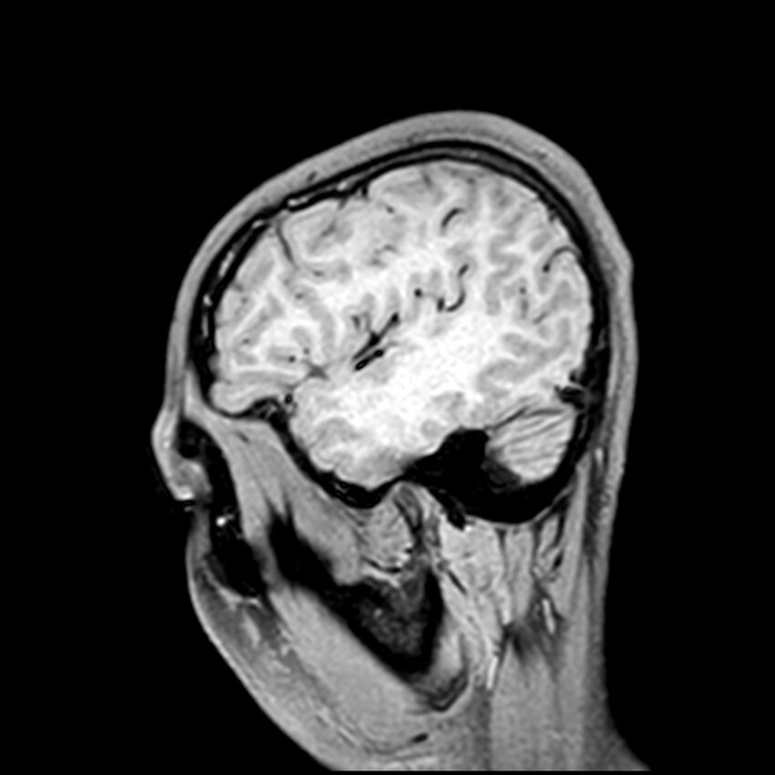Central neurocytoma (Radiopaedia 79320-92380 Sagittal T1 55).jpg