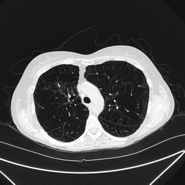 File:Centrilobular pulmonary emphysema (Radiopaedia 24495-24789 Axial lung window 32).jpg