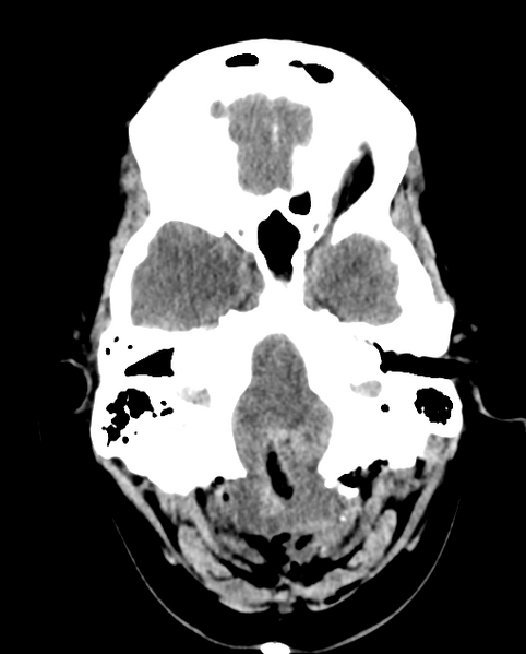 File:Cerebellar ependymoma complicated by post-operative subdural hematoma (Radiopaedia 83322-97737 Axial non-contrast 24).png