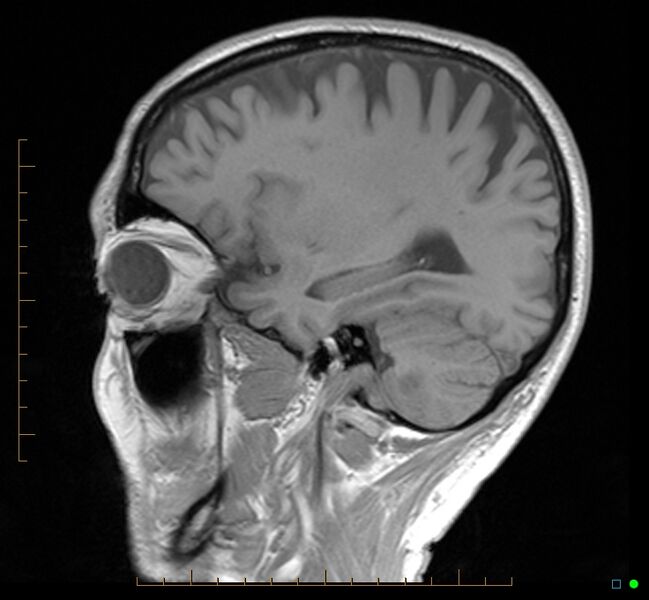 File:Cerebellar gangliocytoma (Radiopaedia 65377-74422 Sagittal T1 12).jpg