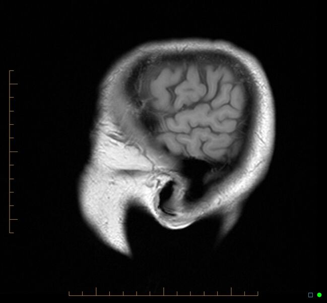 File:Cerebellar gangliocytoma (Radiopaedia 65377-74422 Sagittal T1 2).jpg