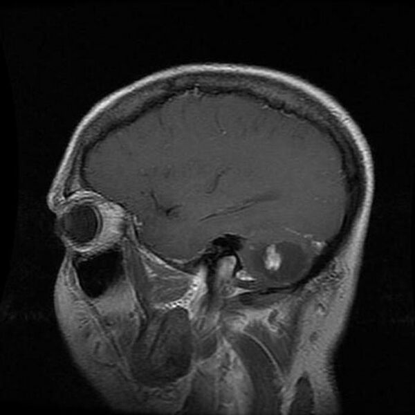 File:Cerebellar hemangioblastoma (Radiopaedia 11472-11835 D 1).jpg