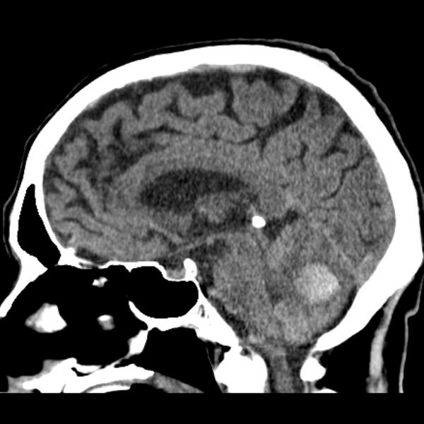 File:Cerebellar hemorrhage (Radiopaedia 27193-27359 C 22).jpg
