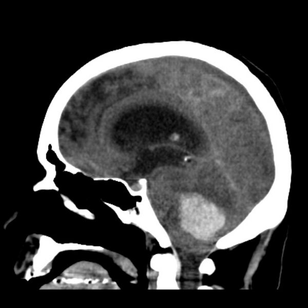 File:Cerebellar hemorrhage causing obstructive hydrocephalus (Radiopaedia 33989-35207 B 24).jpg