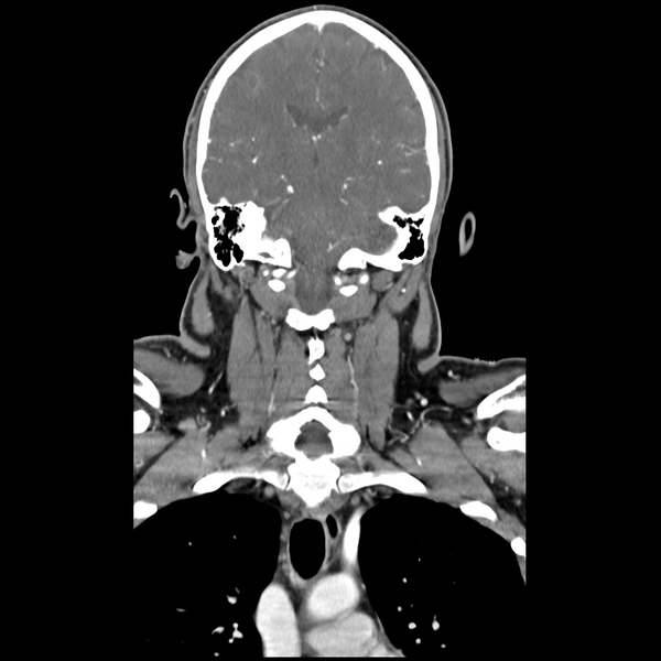 File:Cerebellar infarct due to vertebral artery dissection with posterior fossa decompression (Radiopaedia 82779-97029 D 37).png