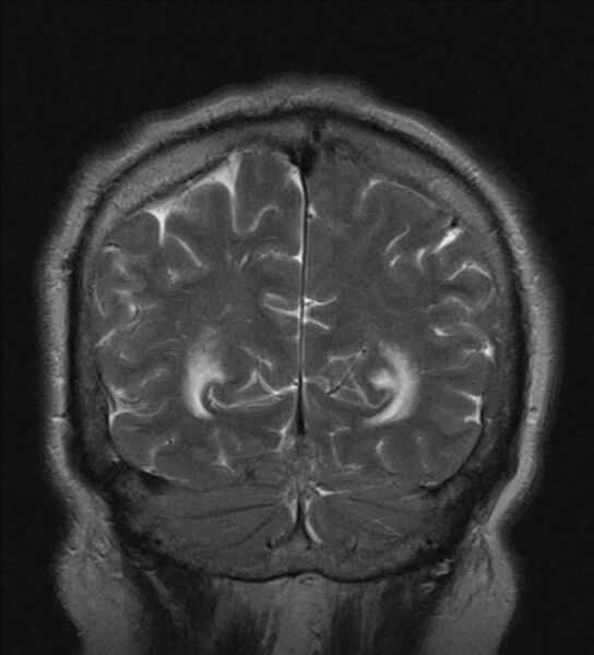 File:Cerebellopontine angle meningioma (Radiopaedia 24459-24764 Coronal T2 21).jpg
