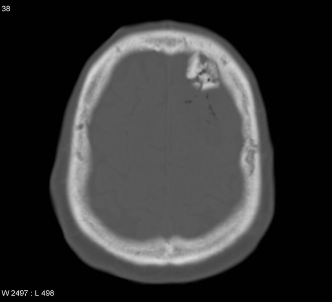 File:Cerebral abscess (Radiopaedia 5150-6933 Axial bone window 2).jpg