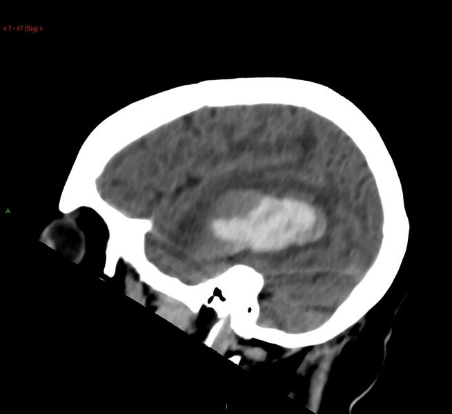 File:Cerebral amyloid angiopathy-associated lobar intracerebral hemorrhage (Radiopaedia 58378-65518 C 47).jpg