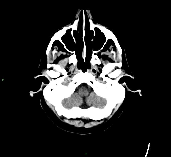 File:Cerebral amyloid angiopathy-associated lobar intracerebral hemorrhage (Radiopaedia 58529-65681 Axial non-contrast 46).jpg