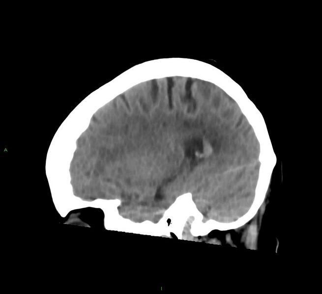 File:Cerebral amyloid angiopathy-associated lobar intracerebral hemorrhage (Radiopaedia 58754-65975 C 14).jpg