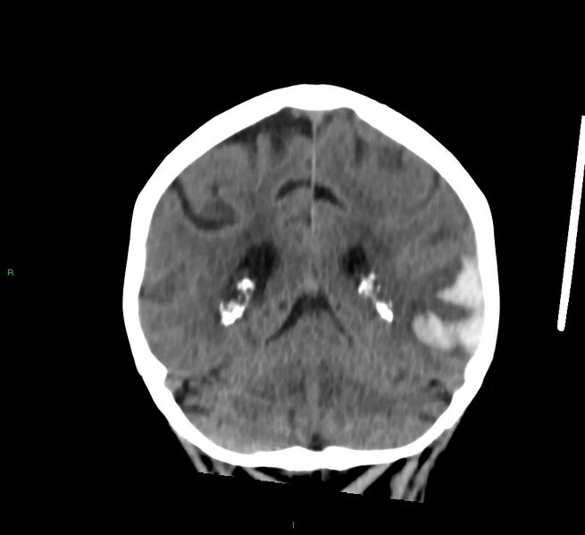 File:Cerebral amyloid angiopathy-associated lobar intracerebral hemorrhage (Radiopaedia 58757-65978 Coronal non-contrast 24).jpg