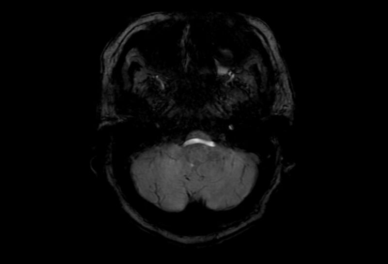File:Cerebral amyloid angiopathy (Radiopaedia 86671-102792 Axial Gradient Echo 49).jpg