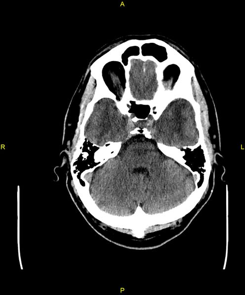 File:Cerebral autosomal dominant arteriopathy with subcortical infarcts and leukoencephalopathy (CADASIL) (Radiopaedia 86108-102051 Axial non-contrast 28).jpg